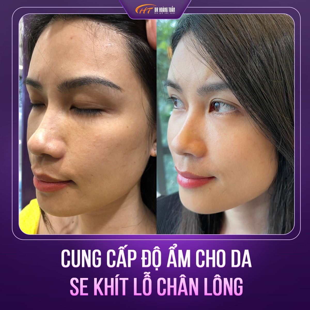 review tiêm BAP 5 điểm